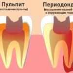 Пульпит и периодонтит: полный справочник лечения