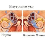 Болезнь Меньера: симптомы, причины и лечение