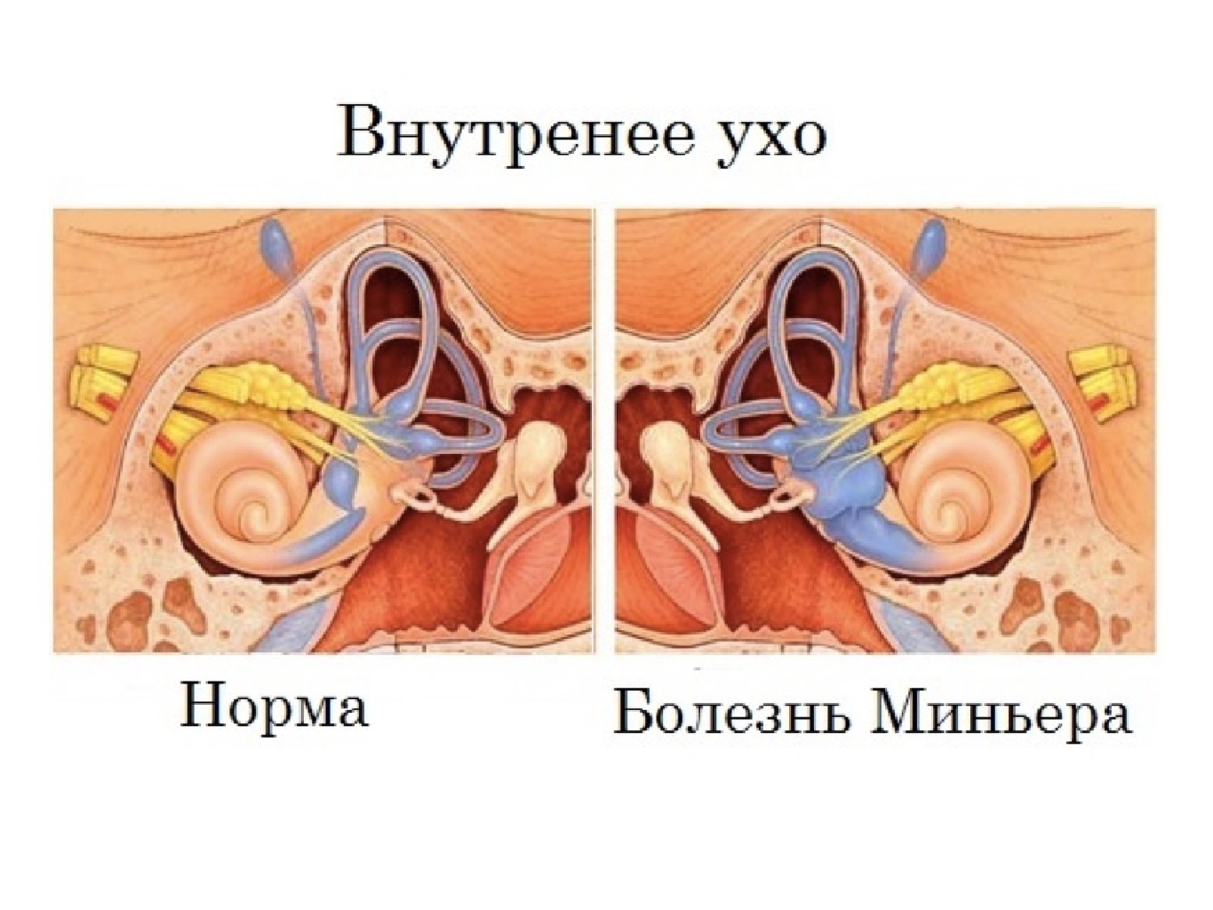 Болезнь Меньера: симптомы, причины и лечение