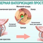 Лазерное удаление простаты: современная терапия аденомы