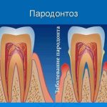 Лечение пародонтоза для здоровых десен.