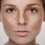 Удаление коричневых пигментных пятен с лица.