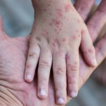 Коксовирусный вирус и бассейны: почему Турция страдает от вспышек?