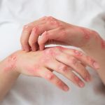 Лишай: как выглядит, чем заразен и как бороться с инфекцией