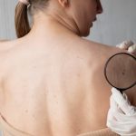 Как самостоятельно осматривать родинки: инструкция для самопроверки